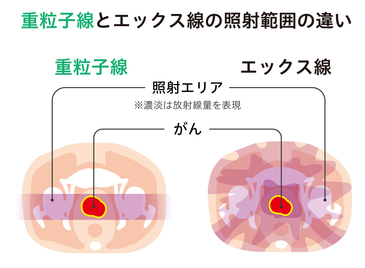 重粒子線とエックス線の照射範囲の違い