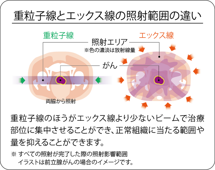 重粒子線とエックス線の照射範囲の違い